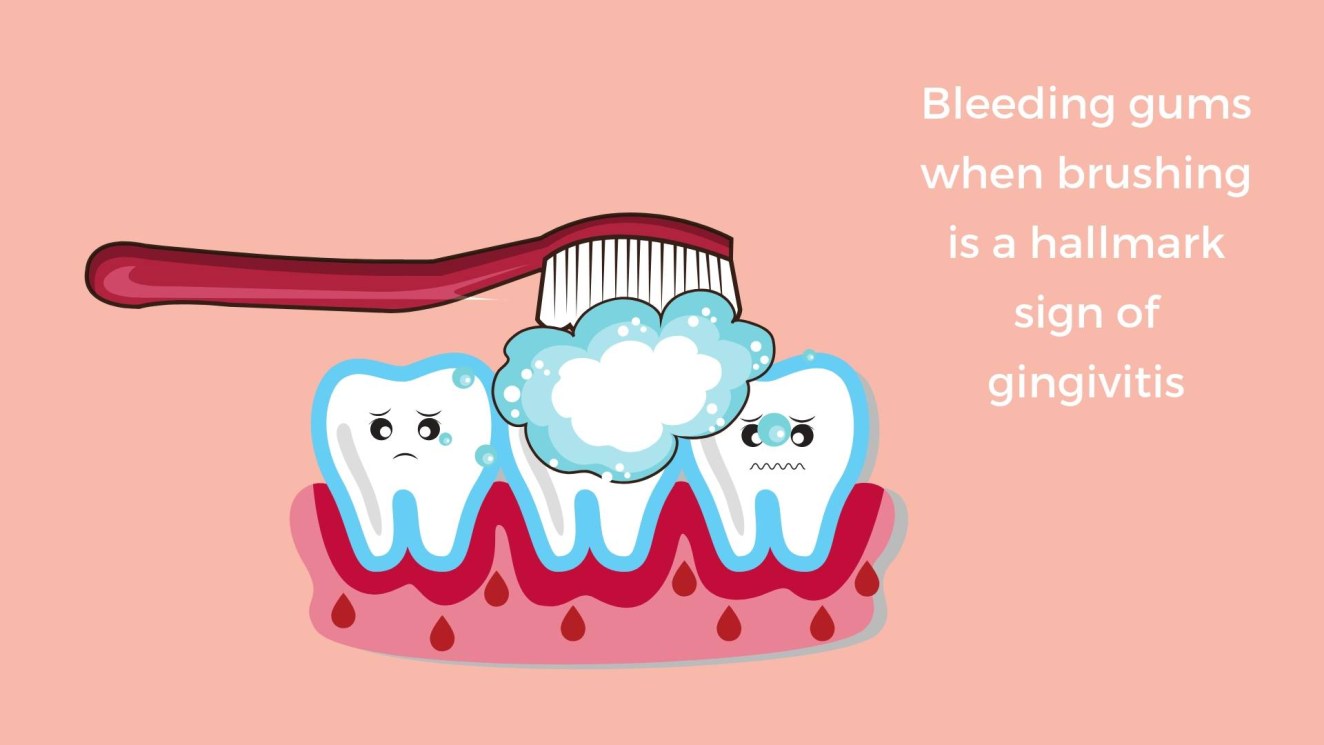 Picture of: Bleeding gums when brushing is a sign of gingivitis – Method Dental